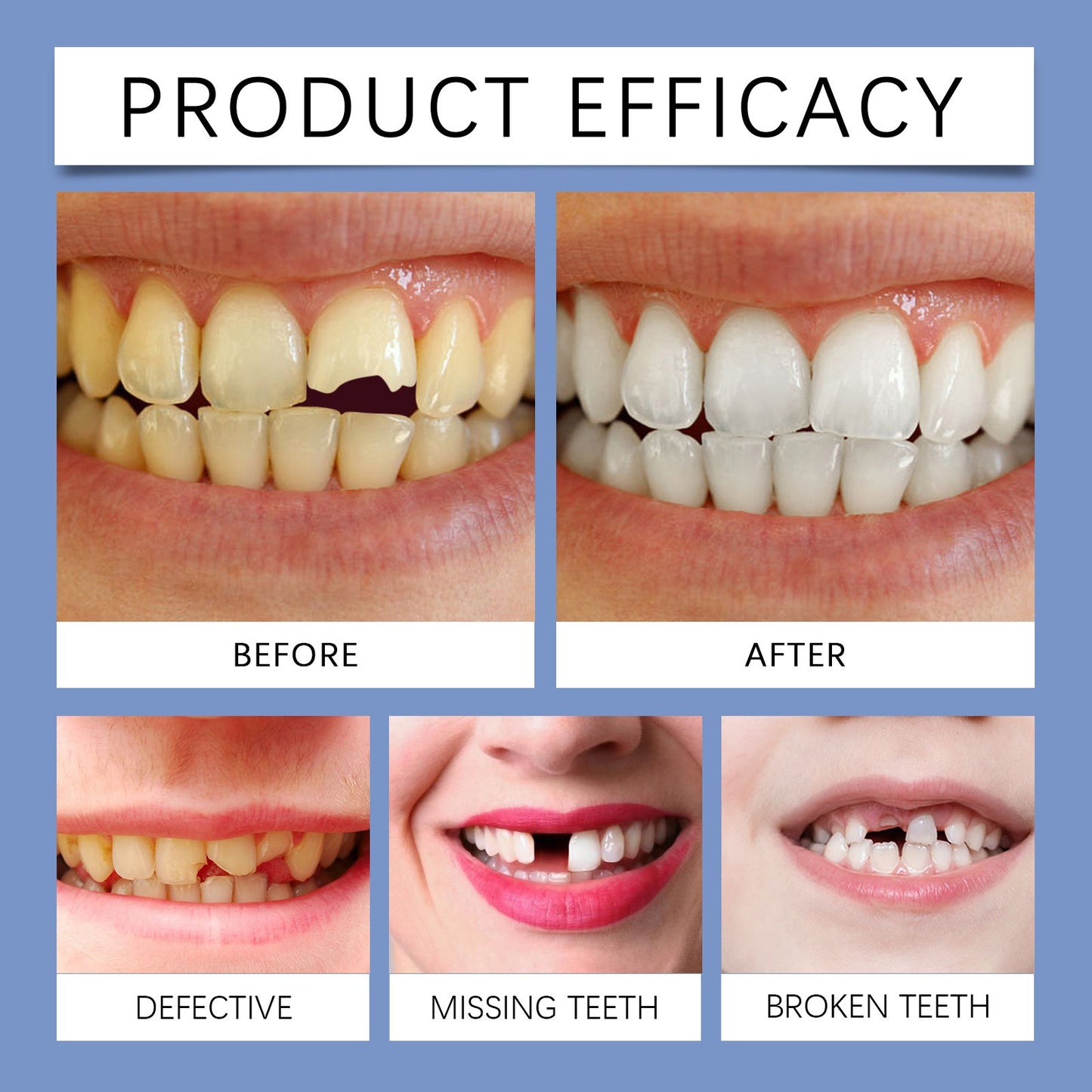At-Home Tooth Whitening Kit with Blue Curing Lamp